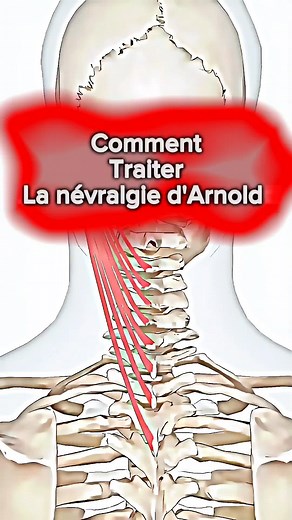 Comprendre la névralgie d'Arnold et ses traitements