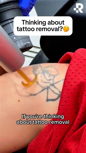 25 tattoos. 25 minutes. 勞 When we say tattoo removal has come a long...