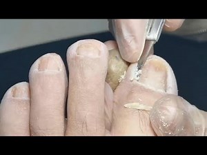 Pedicure Tutorial : Fungal toenail treatment & Ingrown toenail treatment. Ingrown toenail removal.