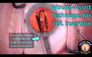 Wound-Assist Technique for IOL Delivery