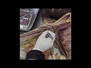 Dissection of axilla