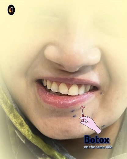 Lip paralysis | Asymmetric Smile Treatment with thread pull/lift