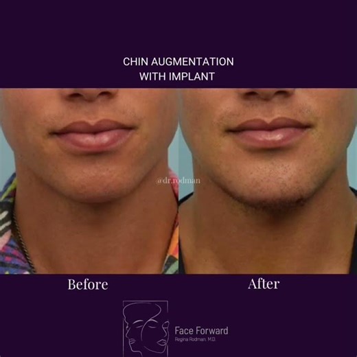 Chin Augmentation| Chin Implant| Genioplasty