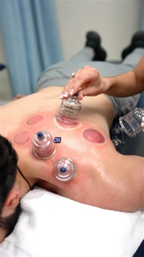 13K views · 8 comments | Cupping uses suction cups to increase blood flow and reduce muscle tension in the shoulder. Kinesio taping applies elastic tape to support muscles and joints, reducing pain and enhancing movement. Together, they can help alleviate shoulder pain and improve function | Precision Care Medical & Sports Performance | Facebook