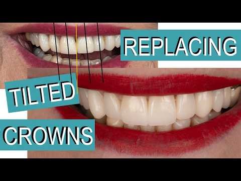 Replacing Four Dental Crowns: A Step-by-Step Approach