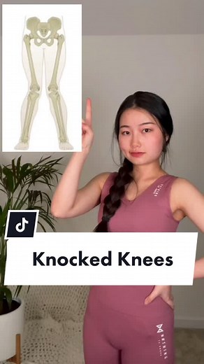 Correcting Knocked Knees: Leg Straightening Exercises and Workout Tips