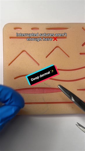 Mastering Deep Dermal Sutures for Surgical Success