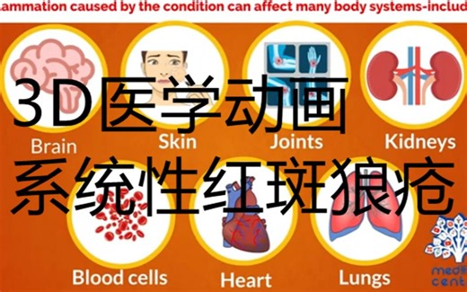 系统性红斑狼疮 (SLE)，原因、体征和症状、诊断和治疗。-3D动画科普