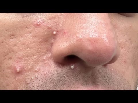 HOW TO GET RID OF WHITEHEADS INSANE