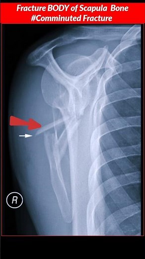 Fracture Scapula Bone // Shoulder Y View #radiographerusn #xray #fracture #bones #radiography