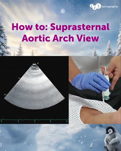 123sonography on Instagram: "In this short demonstration, Prof. Binder shows how to obtain the suprasternal aortic arch view. Look closely and answer the following quiz question: What do you see in this patient's suprasternal notch view? (Choose the correct answer) A) The patient's left pulmonary artery B) The patient's left subclavian artery C) Coarctation of the aorta D) Not much because of bad image quality Don't let this offer melt away and benefit now from -30% and Lifetime Access 👉🏻 Link