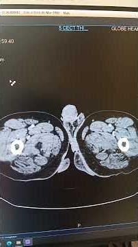 #radiology#ctabd#medicaltranscription##