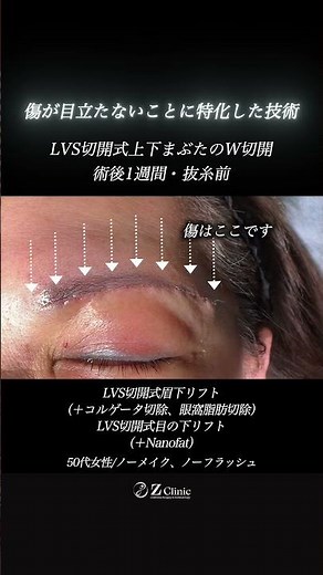 【上下まぶたのW切開｜術後1週間（抜糸前）傷がどこだか分かりますか？】