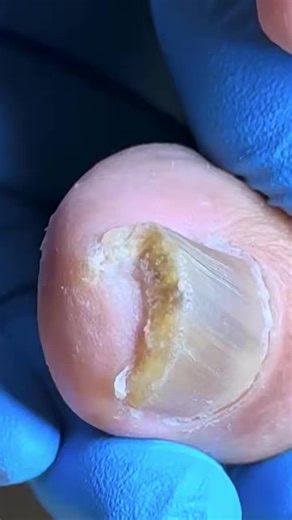 This Toenail Was Hiding a Shocking Secret G98U Beautiful moments of care and relaxation through a gentle pedicure experience. Simple, clean, and satisfying. 🌿✨ Disclaimer: This video follows Fair Use (Section 107) for educational and informational purposes. Clips are from public Chinese sources where Facebook isn’t available, causing no commercial harm. All content is transformed for awareness and not intended to infringe copyright. | Dandruff ASMR