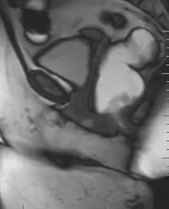 IRM d'une défécation