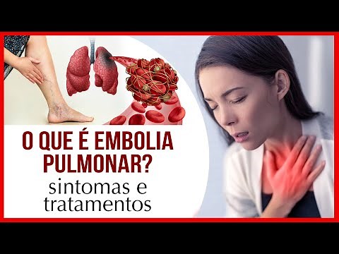 What is Pulmonary Embolism? Symptoms and Treatments.