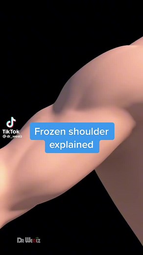 Frozen shoulder explained🤔 Animation by @dr_wealz ♻️Share the post 🗣️Comment below 🚶‍♂️🚶🏿🚶🏽‍♀️Follow @thetrainingroomchiro #thetrainingroomchiro #themasterofdailygrind #chiropractic #rehab #physicaltherapy #fitness #exercise #physicaltherapy #physio #physiotherapy #chiro #mobility #fitness #correctiveexercise #movebetter #movement #sportsrehab #athletictrainer #frozenshoulder #dontbeanicole #strengthandconditioning #personaltrainer #crossfit #powerlifting #olympicweightlifting #Olympiclif