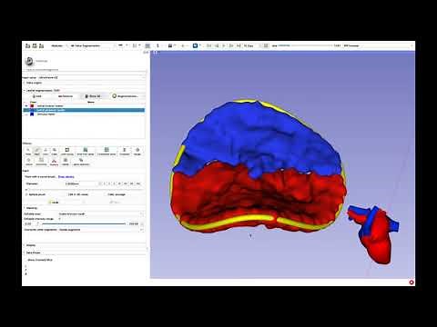 Mitral Valve Analysis: 3DSlicer