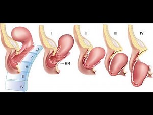 Uterine inversion (uterus turns inside out; Incomplete, Complete, Prolapsed, Total; Causes, symptoms
