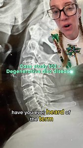 45K views · 1.5K reactions | Case study 102 - degenerative disc...