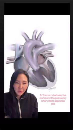 Yaeji K. on Instagram: "Truncus Arteriosus - why are these patients at risk for congestive heart failure?? 🤨🫀 #chdawareness #nicu #truncusarteriosus #medicalillustration #cvicu"