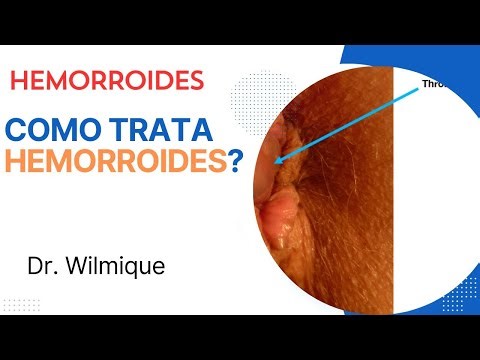 Cómo se trata hemorroides, prevención y diagnósticos