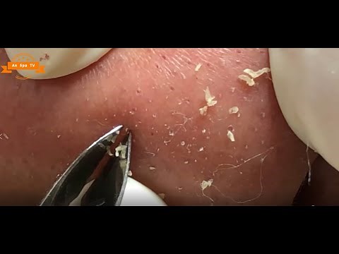 Best Satisfying Nose Plucking Blackheads Whiteheads Removal | Acne Treatment #12