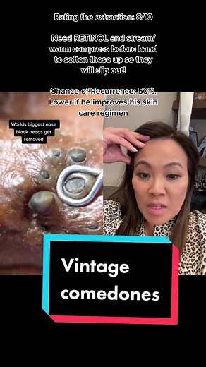 #duet with @vibrantfaces #anyone remember his name? #drpimplepopper #SLMDskincare