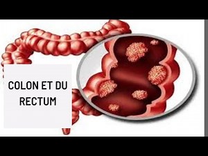 colon et du rectum