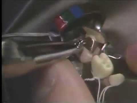 Spot Welded Matrix Band Technique