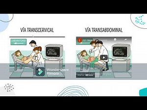Biopsia de las vellosidades coriónicas.