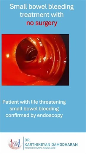Life saving procedure to stop small bowel bleeding - Embolisation