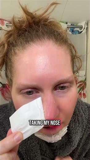 Pore Strips for Blackhead Removal: Effective Skincare Solution