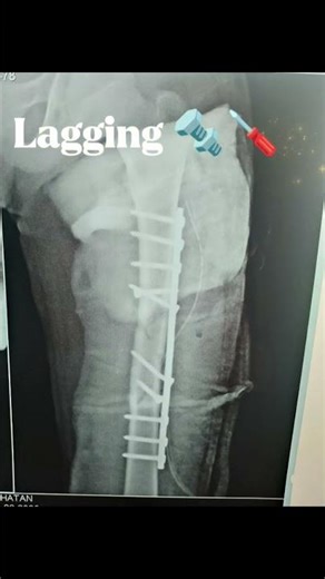 Femur shaft comminuted fracture fixed with narrow DCP#femur #fracture #dcp