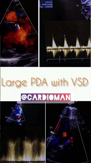 A large Patent Ductus Arteriosus (PDA) with a Ventricular Septal Defect (VSD)🫀#echocardiography