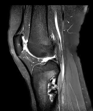 Non ossifying fibroma (NOF) of tibia