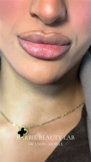 Get Glam with 1ML Russian Lip Fillers in London