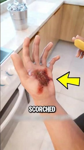 The Reason You Shouldn’t Use Butter on a Burn