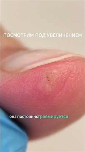 Удаление ногтевой бородавки: почему нужна осторожность