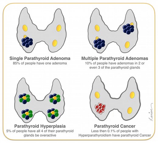 Parathyroid Glands: 4 Gland Parathyroid Assessment | Dr. Babak Larian