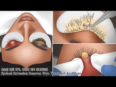 ASMR Oddly Satisfying Dirty Lashes Deep Cleaning & Stye Treatment Animation