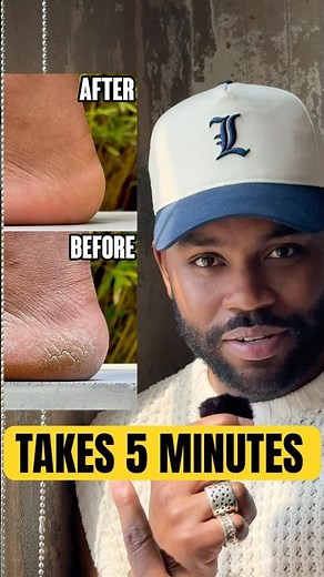 How To FIX your CRUSTY feet