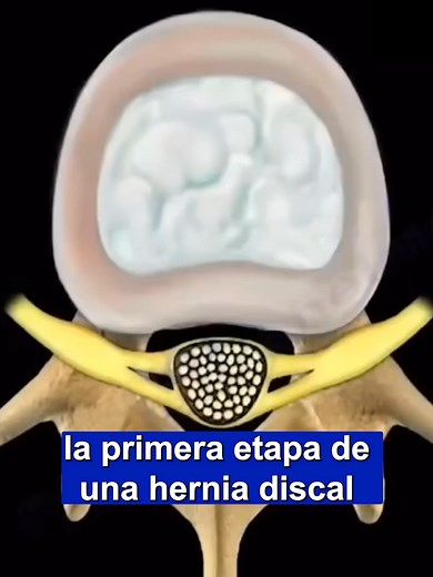 3 Etapas de la Hernia Discal: Protrusión, Extrusión, Secuestro