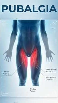¿Qué es la pubalgia?