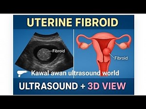 Uterine Fibroid on Ultrasound – Types & Appearances Explained #ultrasound #womenhealth