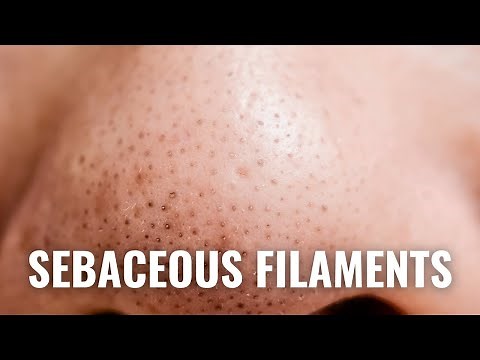 How To Get Rid of Sebaceous Filaments QUICKLY