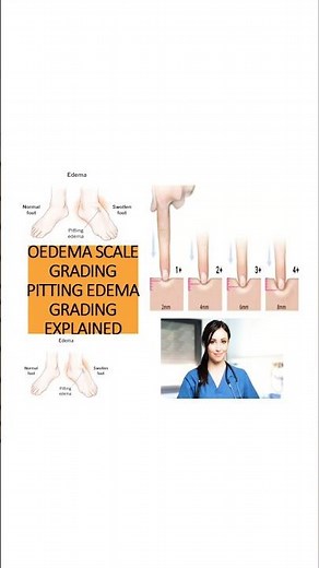 🦵🏻Oedema Scale Explained| Pitting Edema Grades for Nurses & Med Students #Shorts"#OedemaScale#nurse