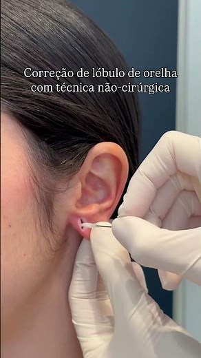 Tratamento de furo de orelha (rasgo na orelha) de forma conservadora, sem cirurgia.