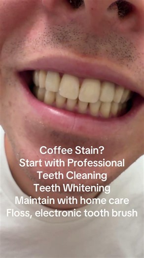 How to remove coffee stain from teeth? #dentist #prophylaxe