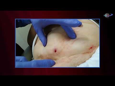 WCW: Wound Management Strategies for an Abdomen Wound